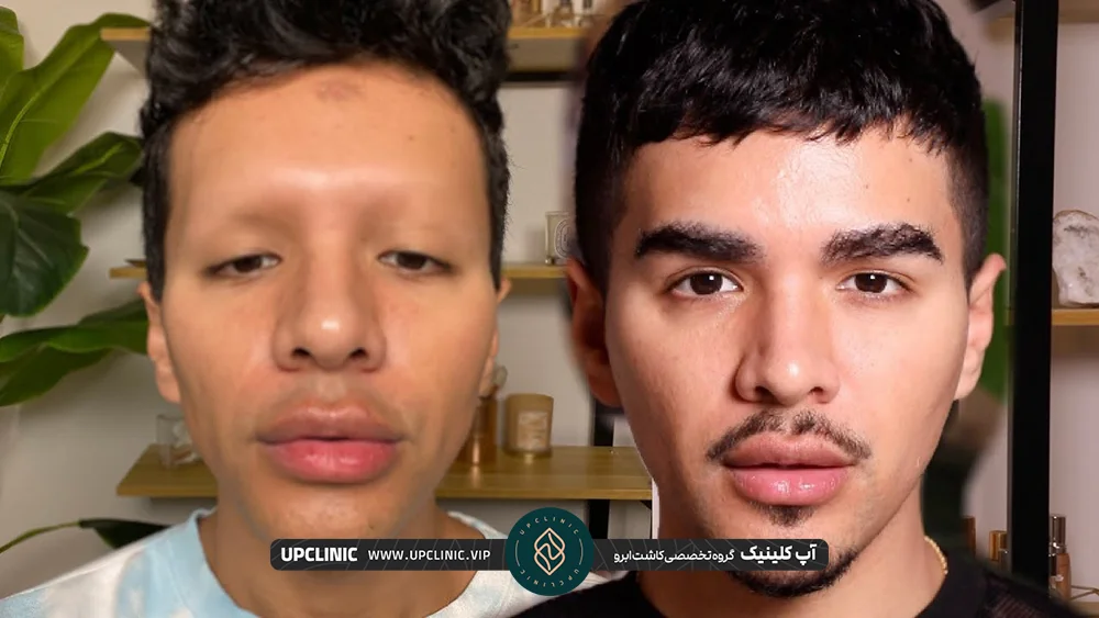 مرد جوان که بخاطر آلوپسی ابروهای خود را از دست داده که در تصویر سمت راست کاشت ابرو انجام داده است