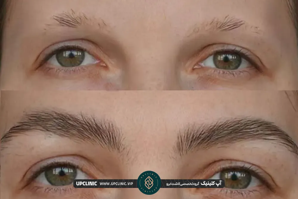 Natural eyebrow implantation