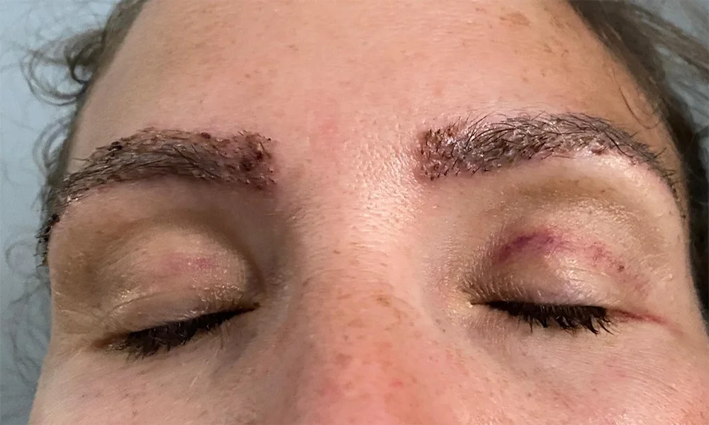 عکس بعد از پیوند ابروی زن - کاشت ابرو روی زخم