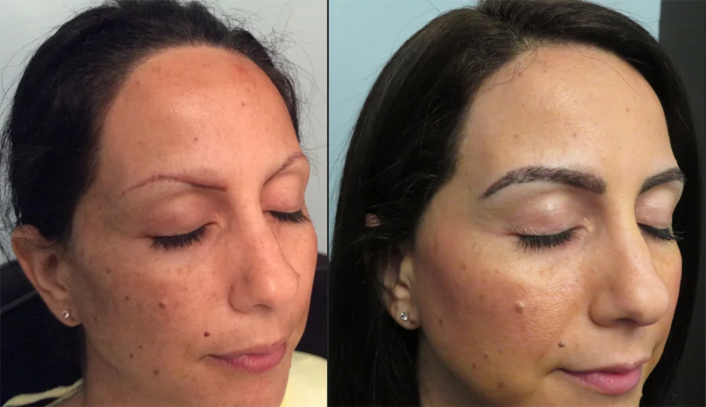 عکس قبل و نتایج بعد از کاشت ابرو