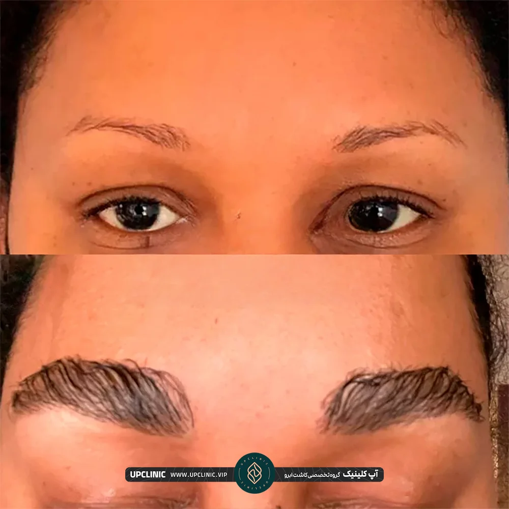 عکس قبل و بعد کاشت ابرو FUT زن