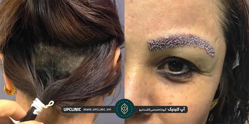 عکس از بعد کاشت ابرو fut و ناحیه برداشت مو