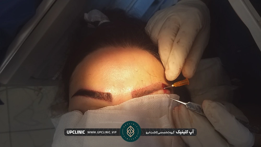 دکتر در حال کاشت ابروی زن جوان