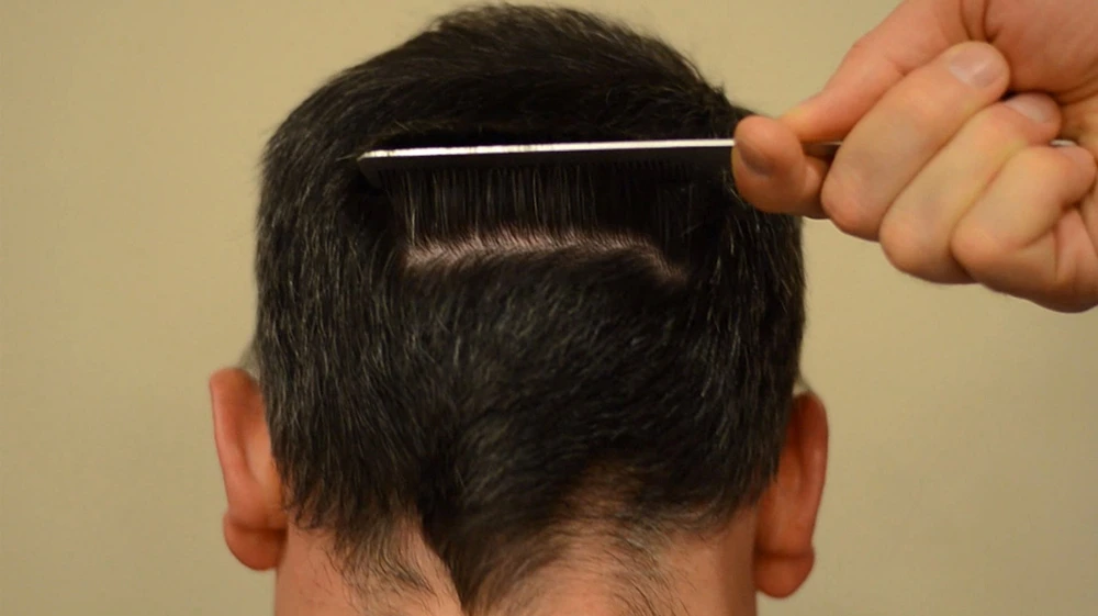 اسکار پشت سر بعد از کاشت ابرو اف یو تی