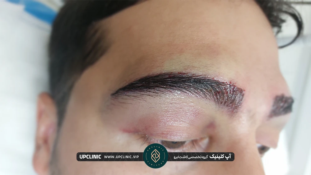 مردی که کاشت ابرو انجام داده و چشم او ورم کرده