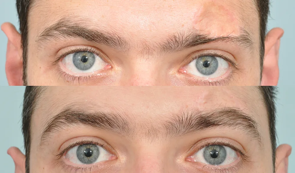 عکس نزدیک از قبل و بعد کاشت ابروی مردانه