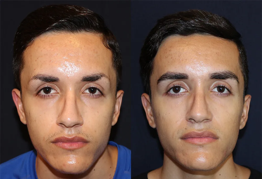 عکس نتایج قبل و بعد کاشت ابروی مرد جوان