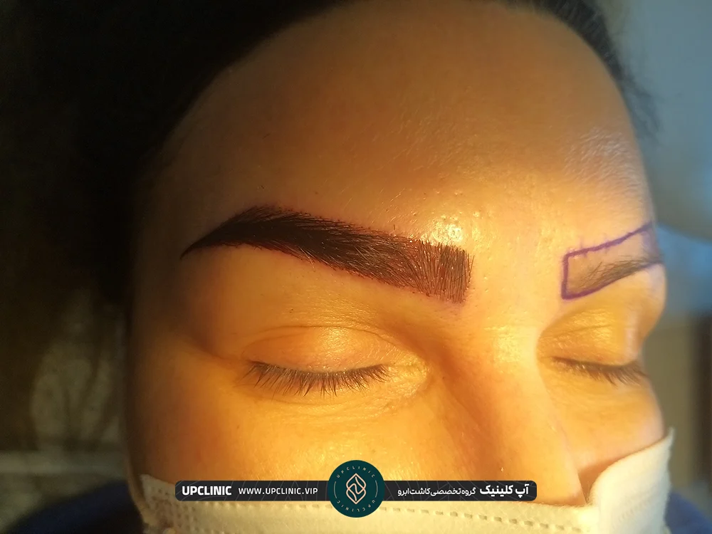 فرآیند کاشت ابروی زن که ابروی راست او کاشته شده است - کاشت ابرو طبیعی