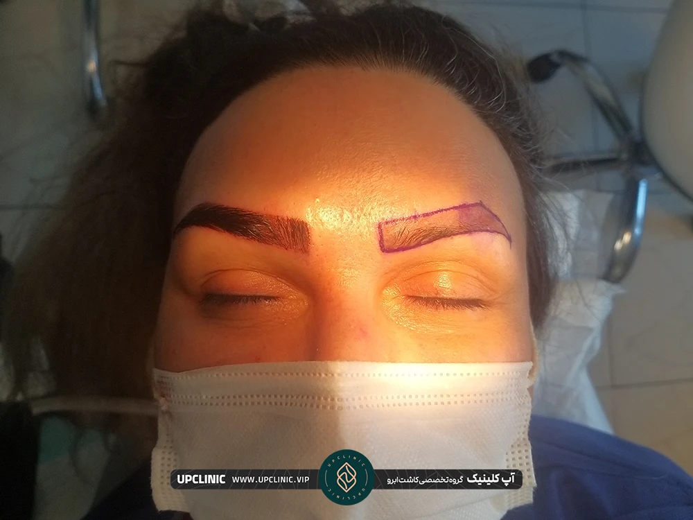 کاشت ابروهای زن که ابروی راست کاشته شده و ابروی چپ هنوز کاشته نشده است