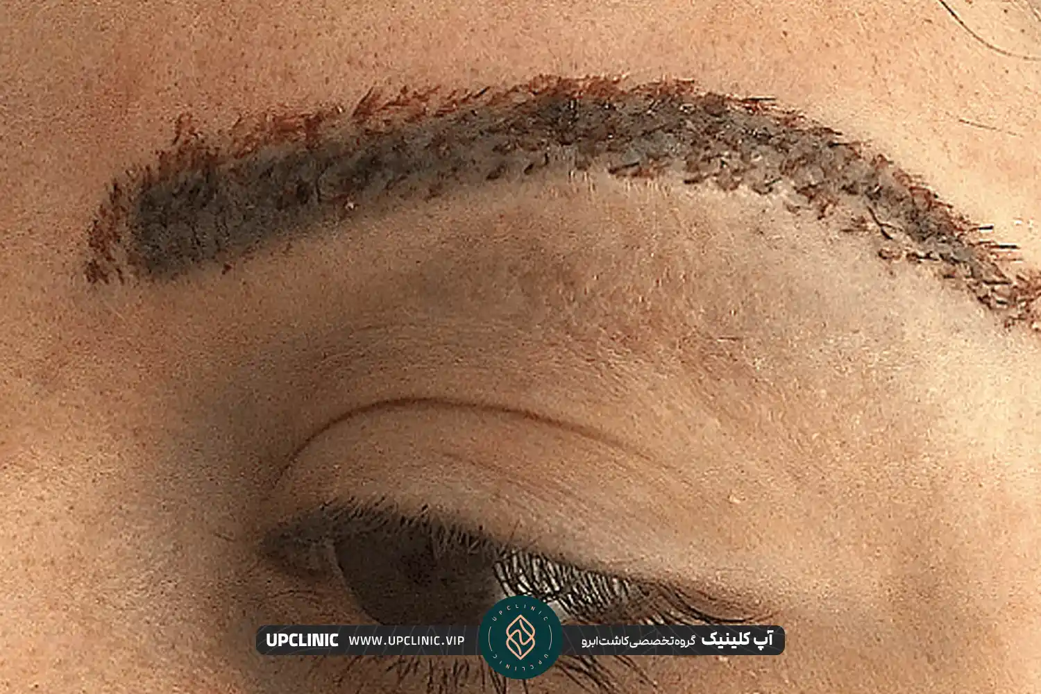 عکس ابروهای زن جوان که تازه کاشته شده است