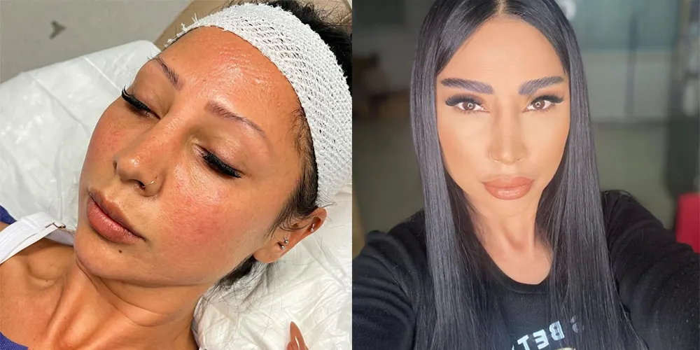 عکس قبل و بعد کاشت ابروی خانم جوان - کاشت ابرو زنانه