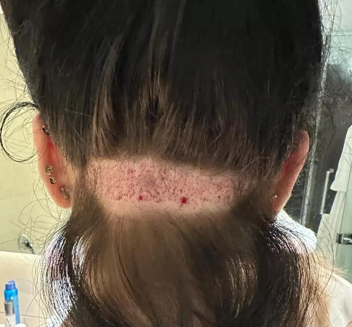 ناحیه برداشت گرافت مو از پشت سر زن