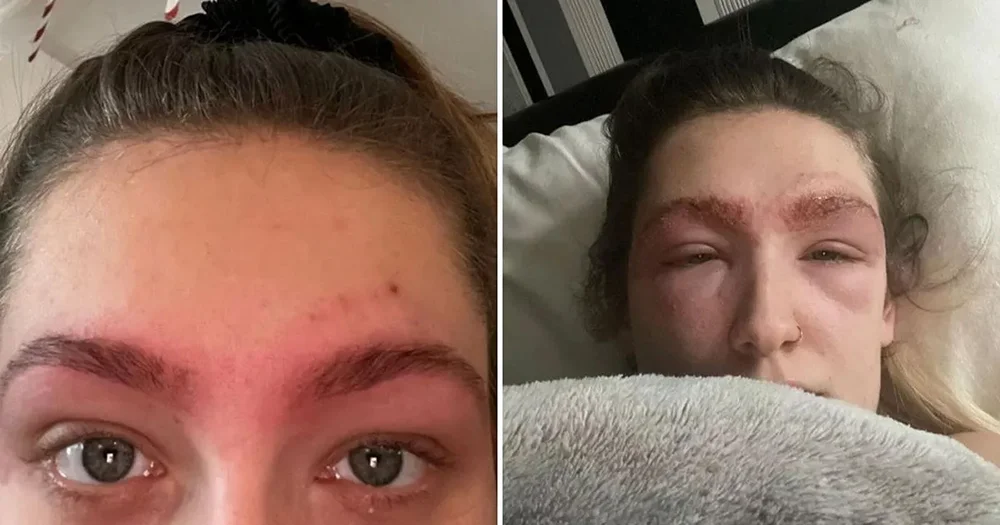 عکس قرمزی ابرو در چپ و عکس ورم ابروها در راست بعد از کاشت