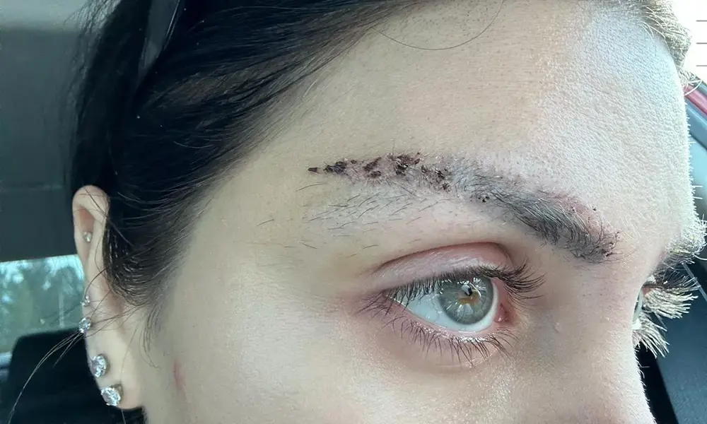 زخم بعد از کاشت ابروی دختر