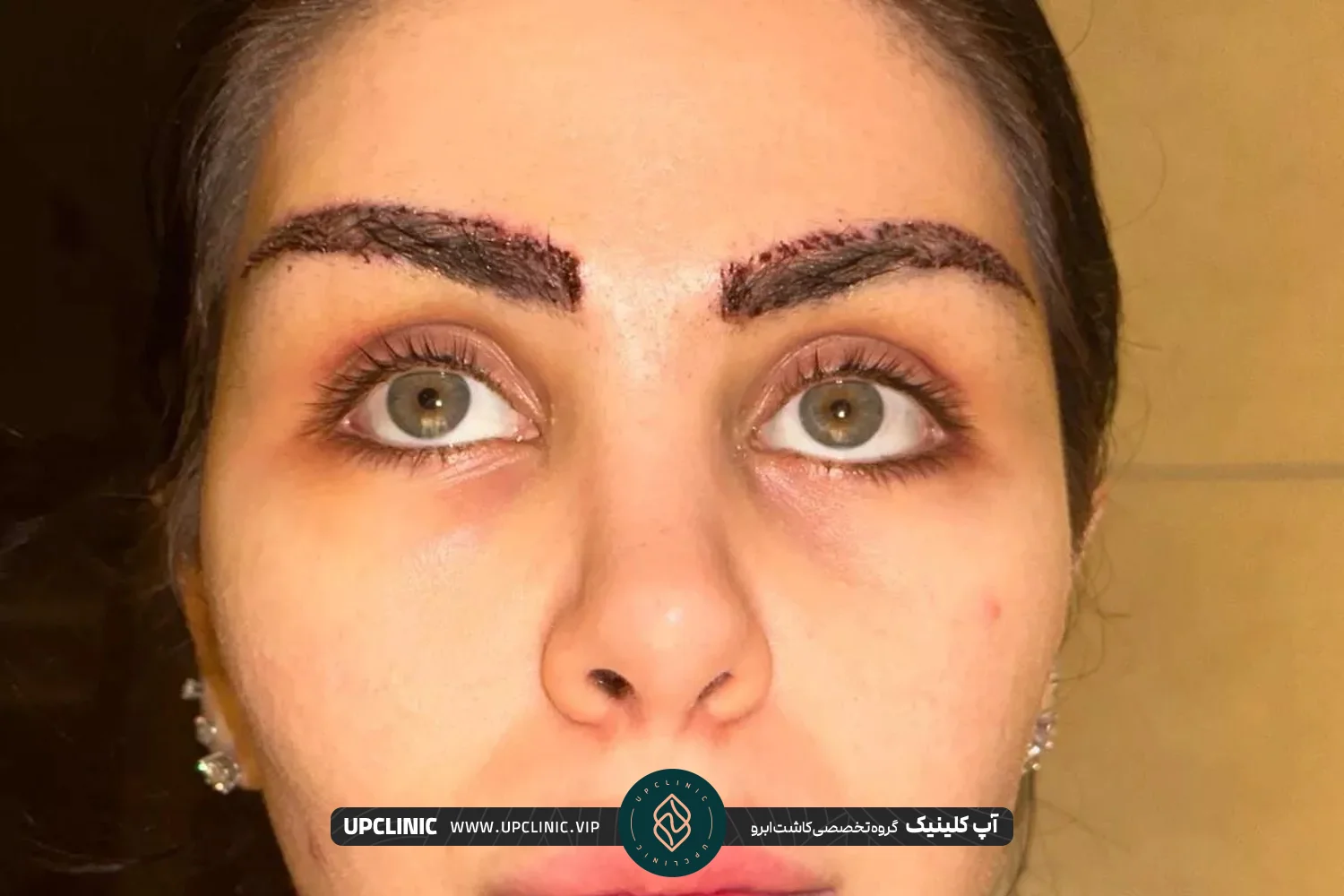 کاشت ابروی زن جوان در غرب تهران