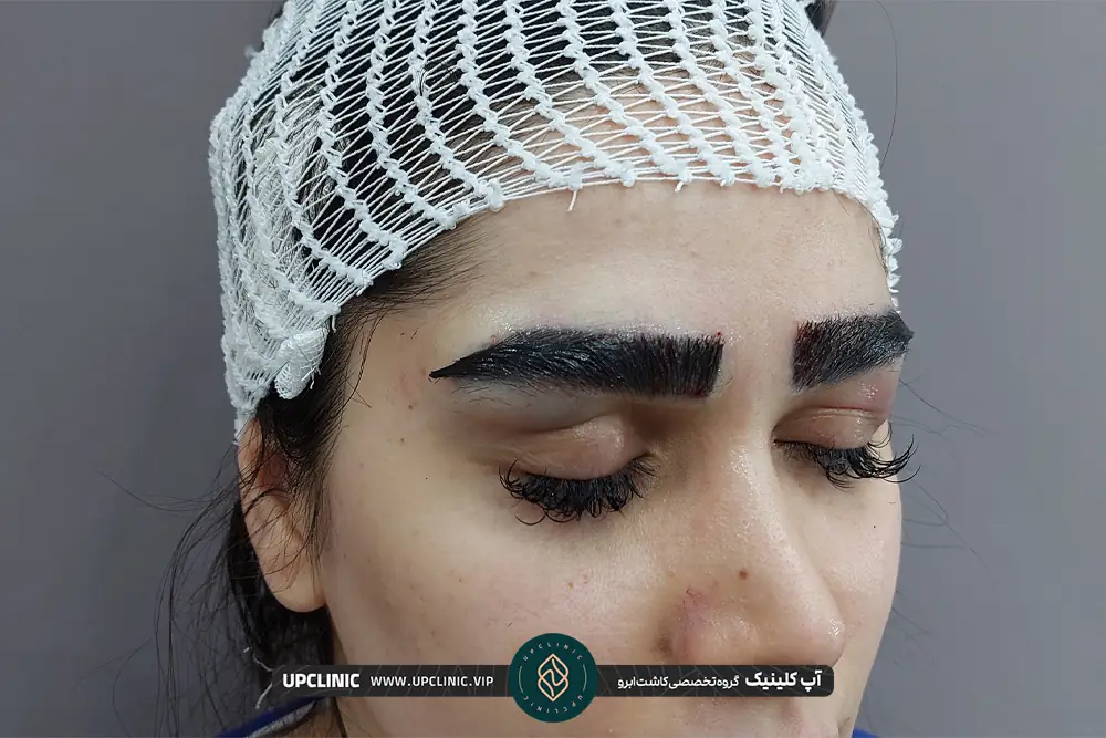 نتایج کاشت ابروی دختر جوانی که سر اون بانداژ بسته شده است - کاشت ابرو در تهران