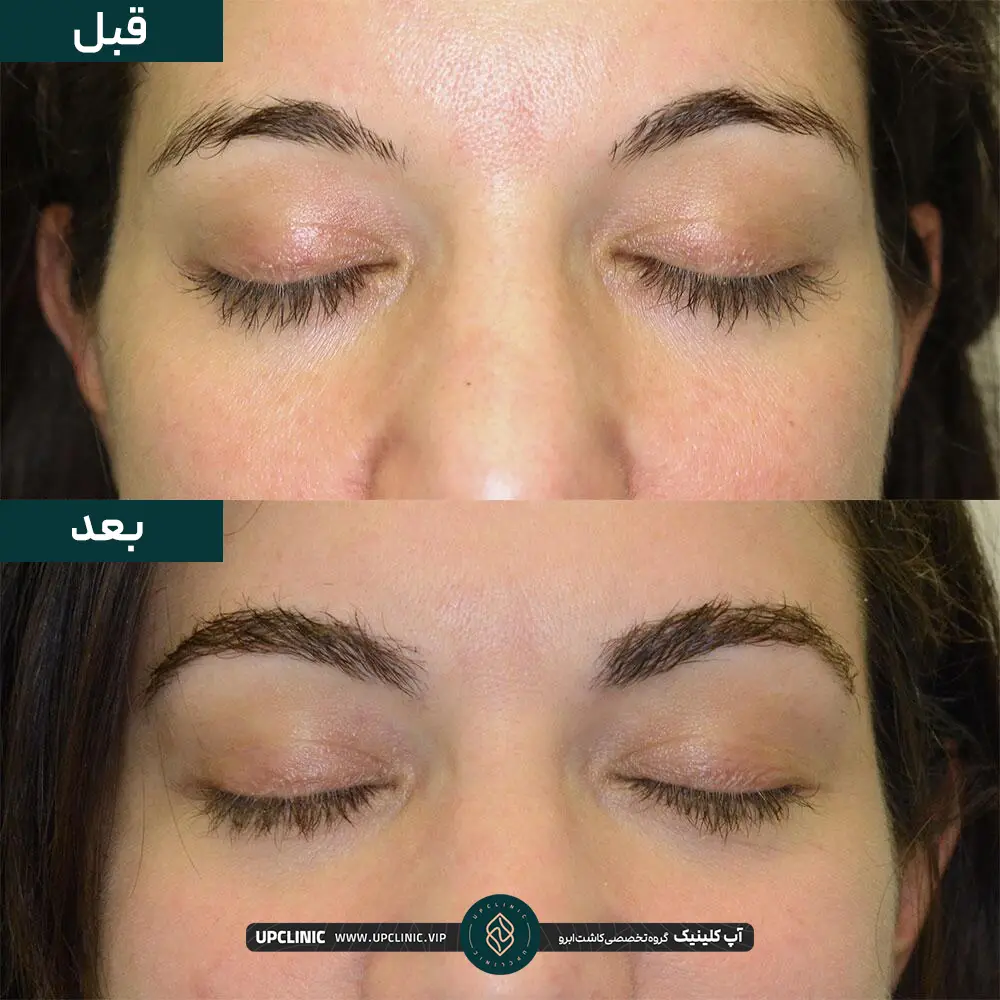 عکس قبل و بعد کاشت ابرو دختر جوان - ماندگاری کاشت ابرو