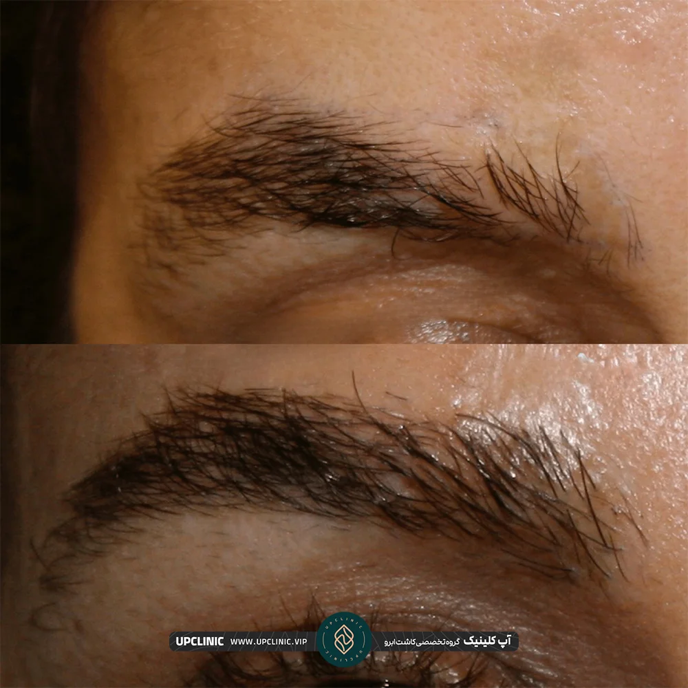 عکس قبل و بعد کاشت ابروی FUE
