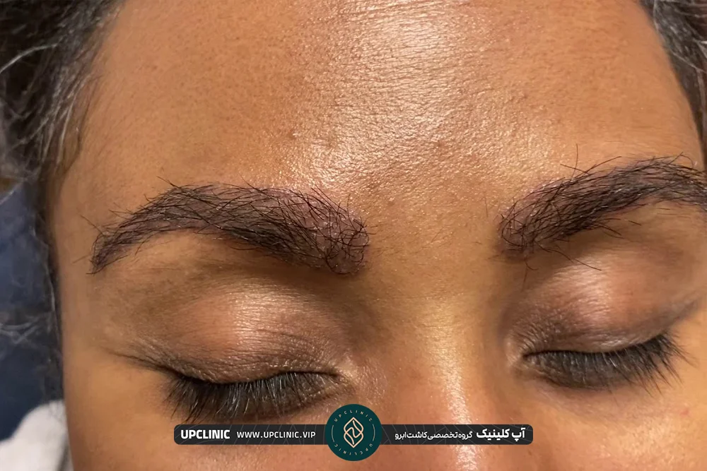 زن جوان که کاشت ابرو انجام داده است - کاشت ابرو به روش FUE