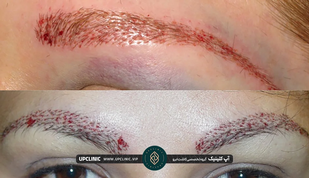 عکس از بعد از کاشت ابرو و عوارضی مثل قرمزی بعد از کاشت ابروی FUE