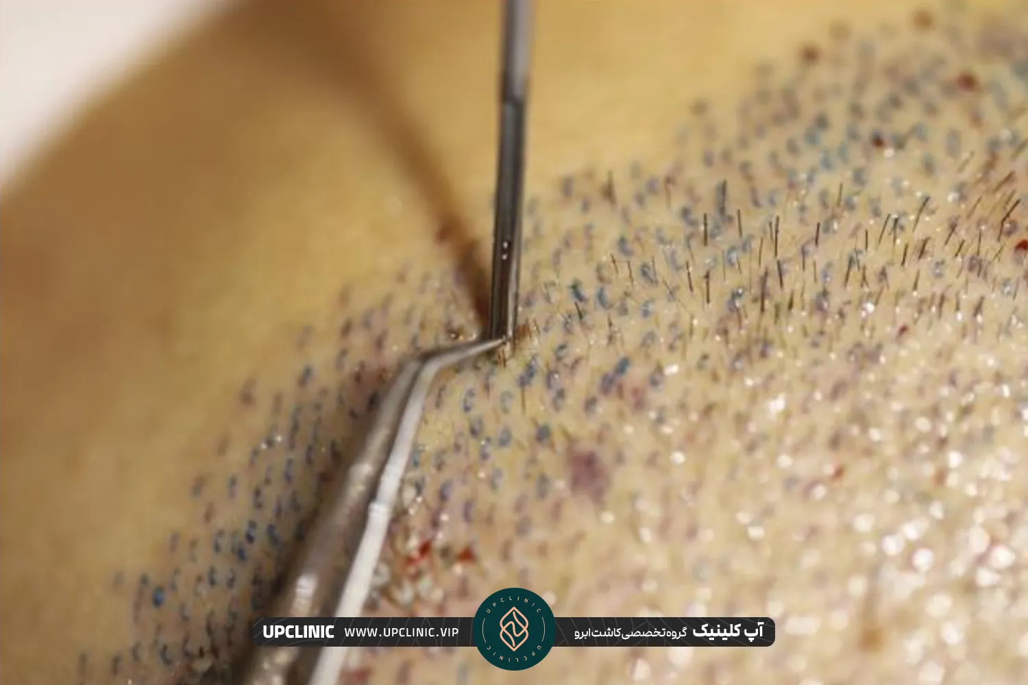 عکس برداشت گرافت های مو از سر مراجعه کننده برای کاشت در ابرو