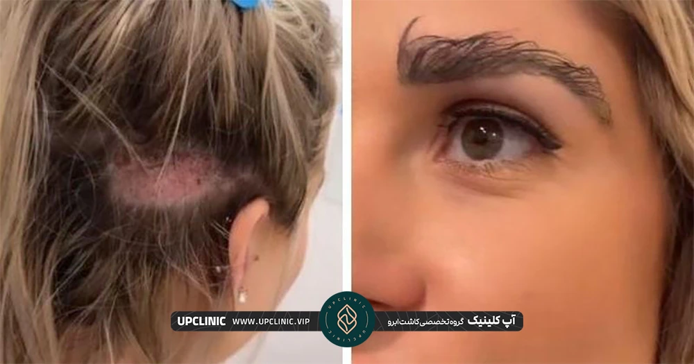 عکس بعد از کاشت ابرو میکروگرافت زن جوان و ناحیه اهدا کننده مو
