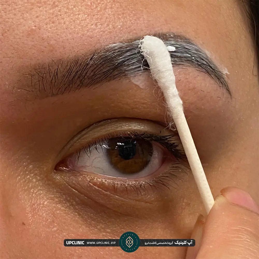 استفاده از پماد روی ابرو بعد از کاشت برای رفع خارش
