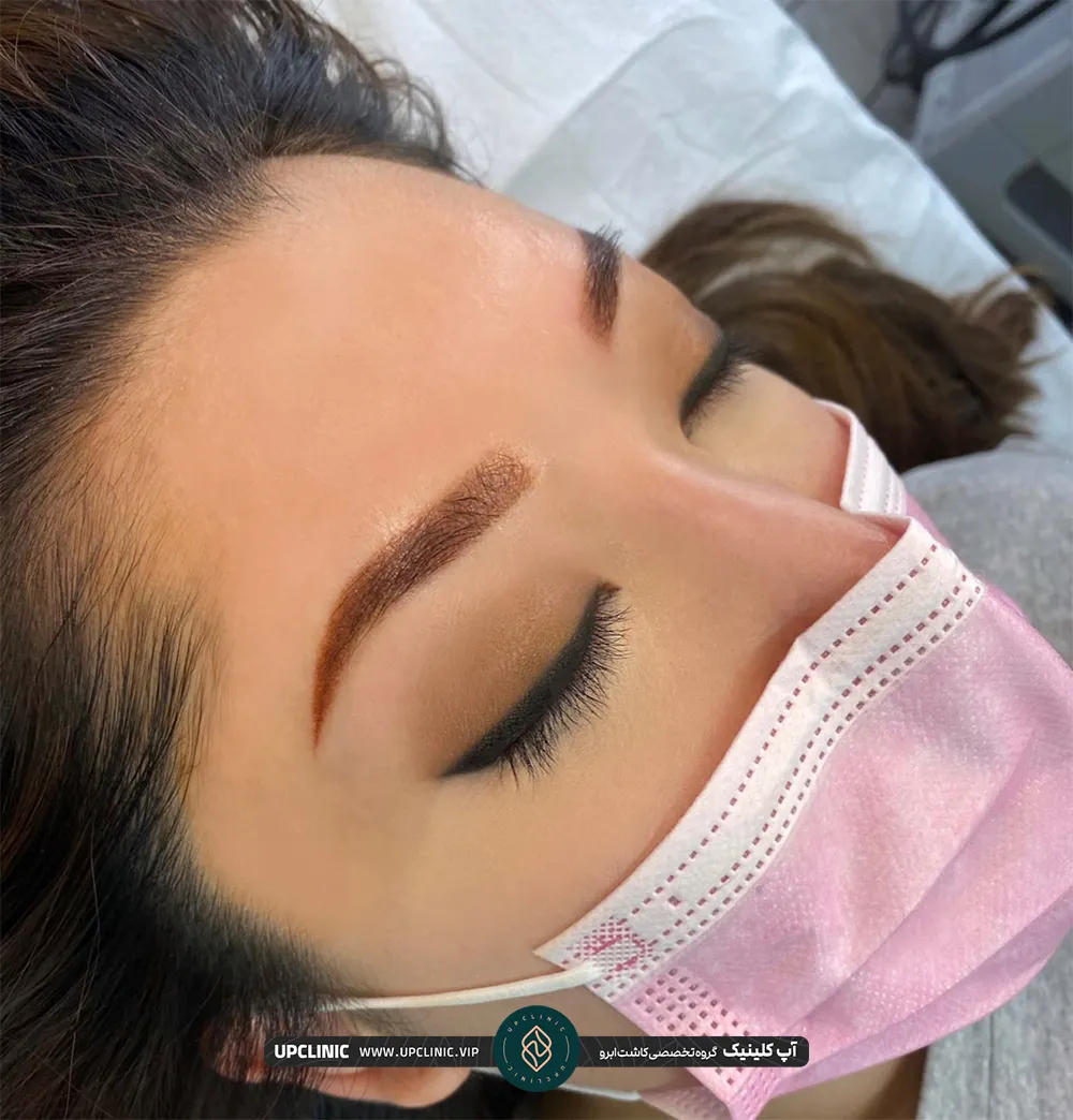 عکس زن جوان که ماسک به صورت دارد و کاشت ابرو انجام داده