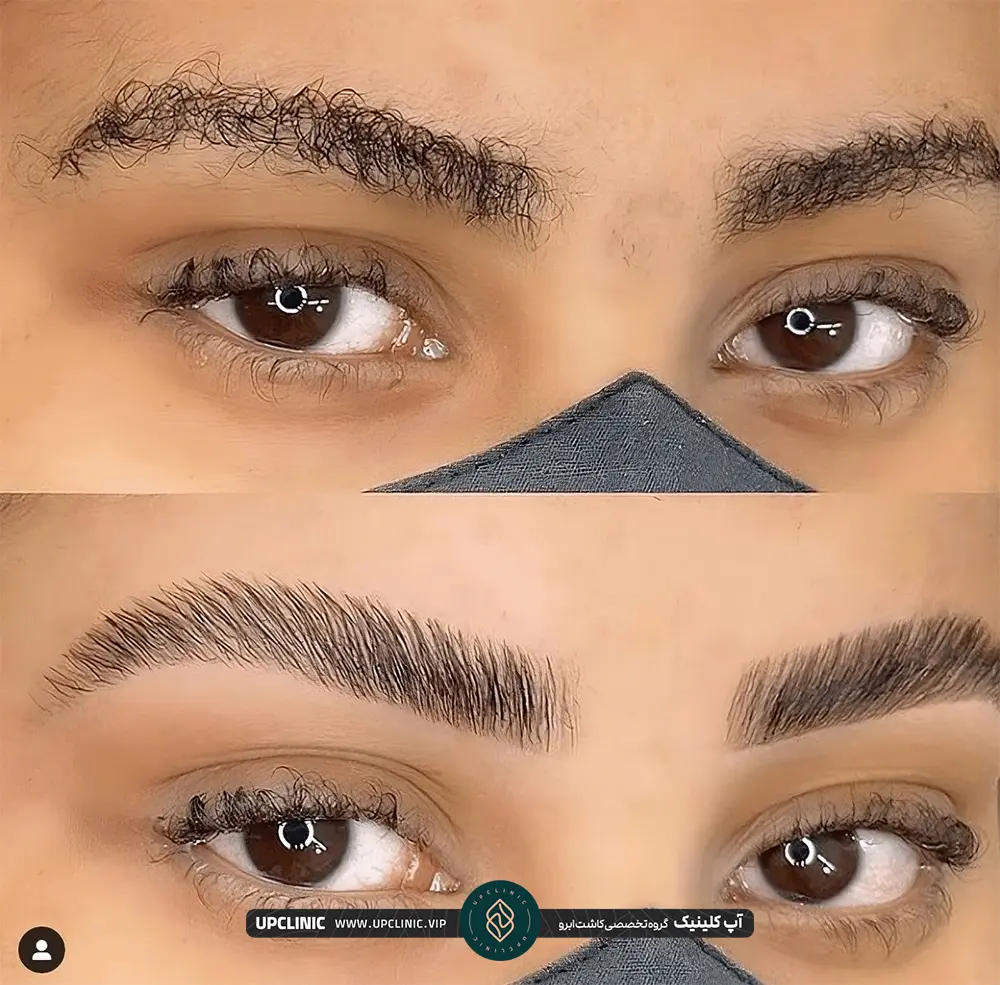 عکس قبل و بعد از دختری که ابروهای فر داشته است که بعد فری ابروها رفع شده است