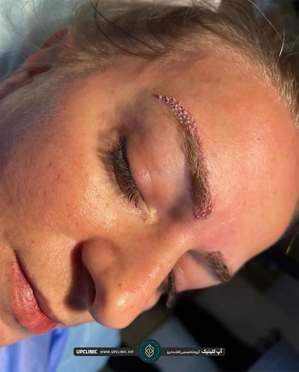 خانم که کاشت ابرو انجام داده است