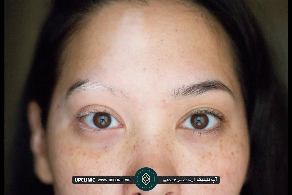 زن جوان که ابروی راست او سفید شده است