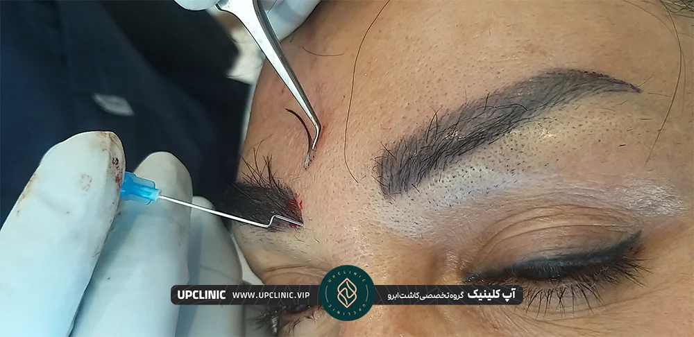 پزشک در حال کاشت ابروهای دختر جوان - ریزش ابرو بعد از کاشت
