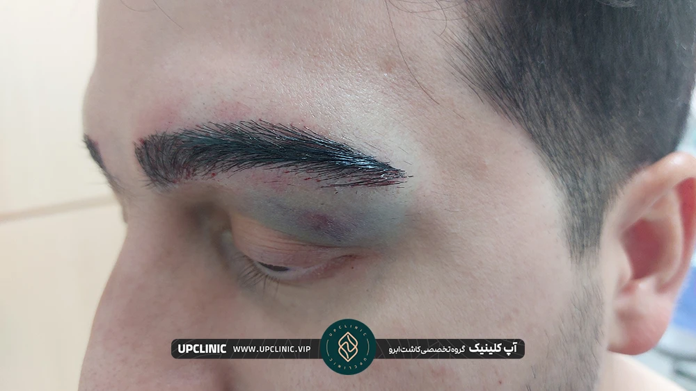 بالای پلک چشم مرد بخاطر کاشت ابرو کبود شده و ورم کرده است