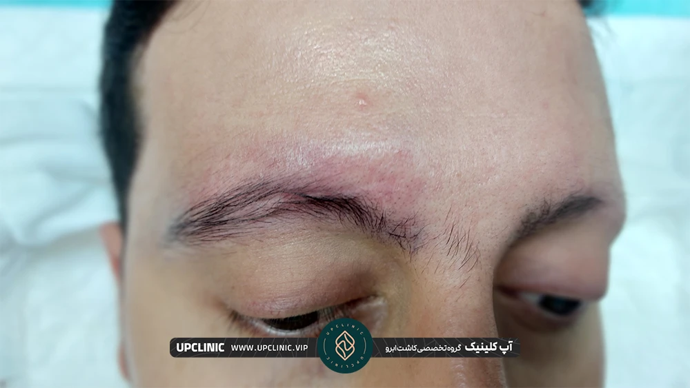 بالای ابروی مرد بخاطر کاشت ابرو قرمز شده است