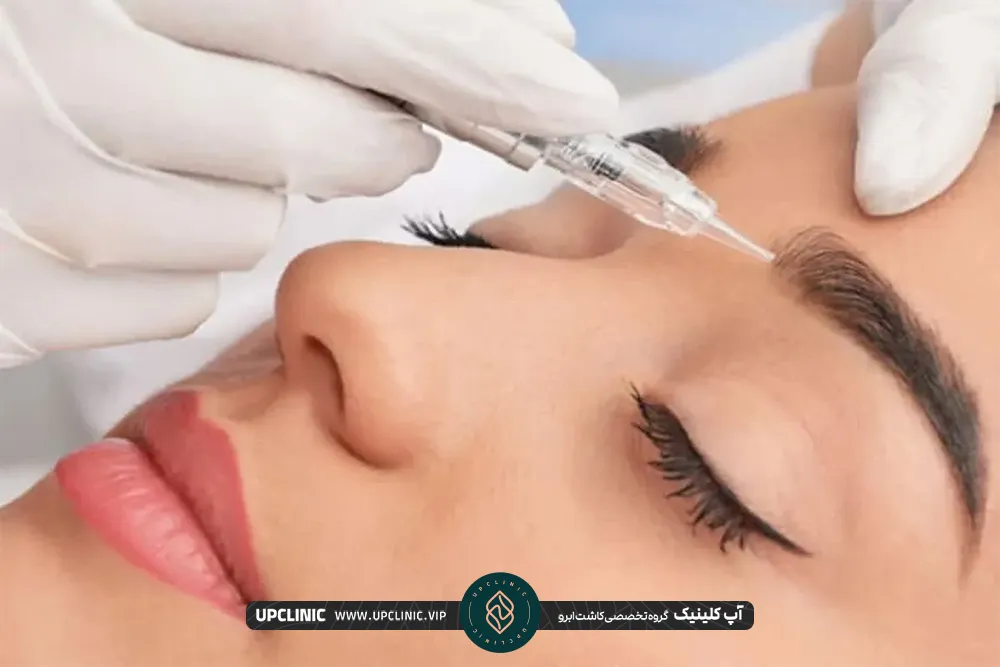 Eyebrow implantation by SUT method