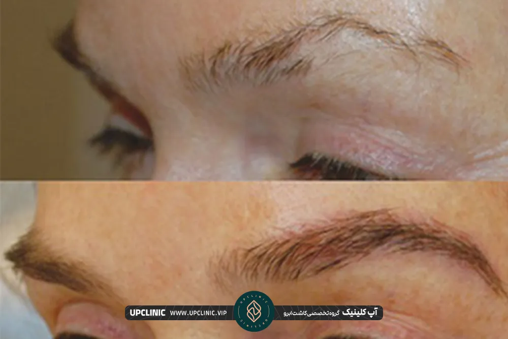FUT eyebrow implantation