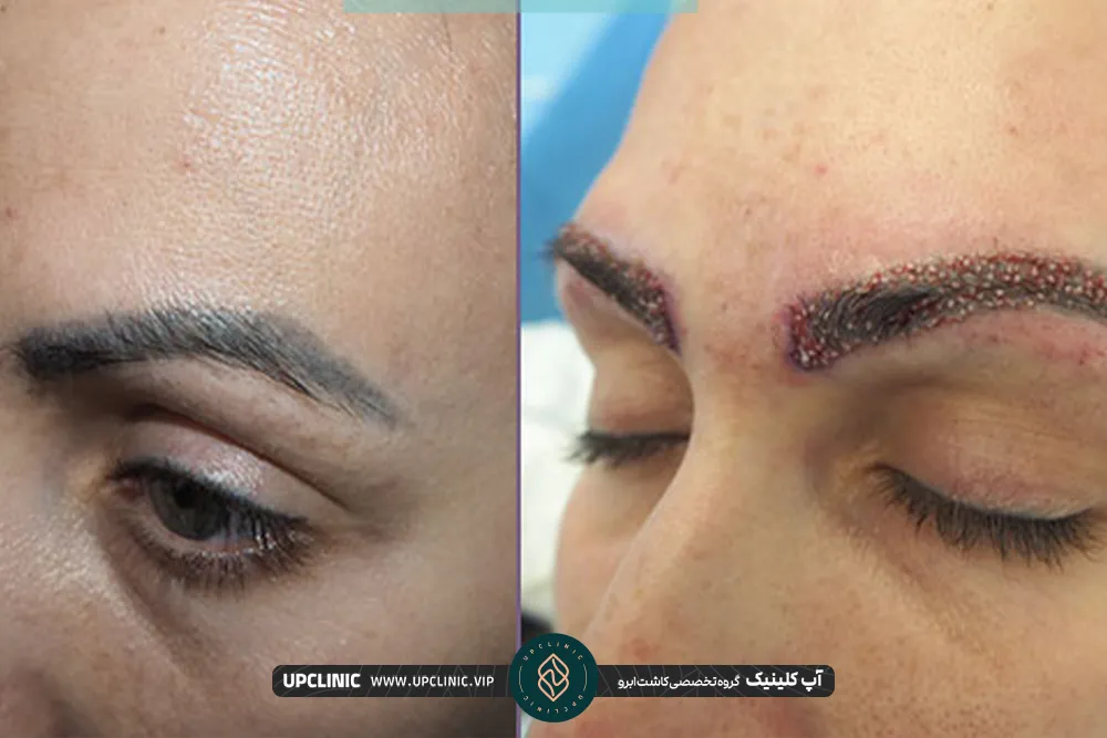 خانمی که بعد از کاشت ابرو دلمه زده و بعد از مراقبت دلمه ها خوب شدند