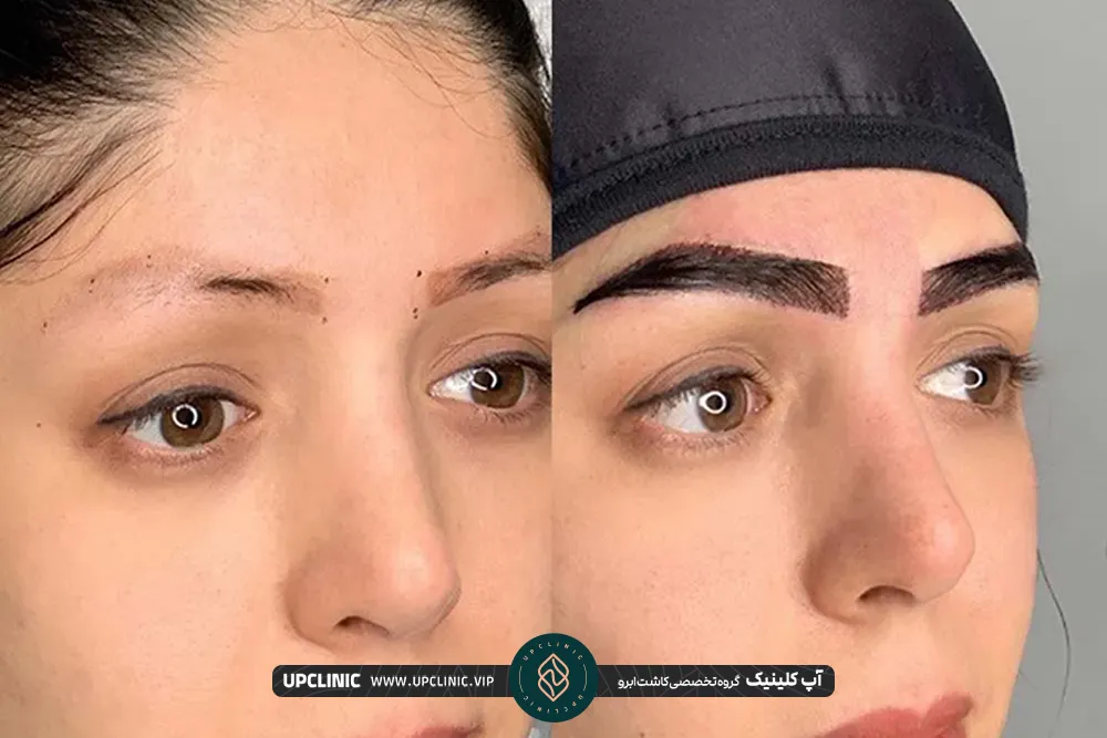 قبل و بعد ابرو یک خانم بعد از انجام کاشت ابرو 