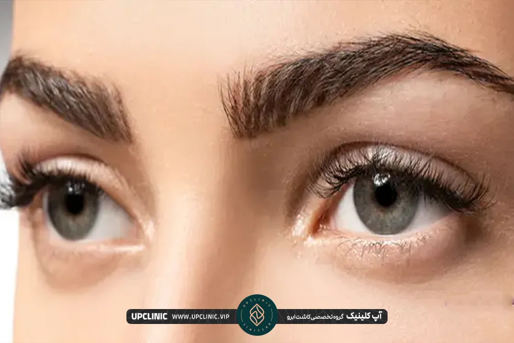 یک فرد که بعد از کاشت ابرو  رو به رو را نگاه مینکند