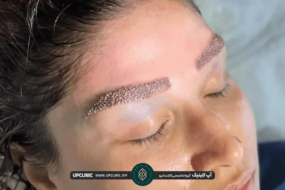 خانمی که بعد از کاشت ابرو ابروهایش دلمه میزند