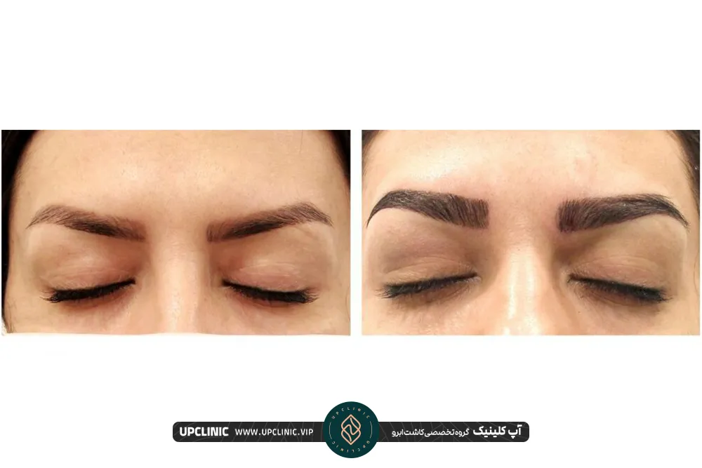 The cost of eyebrow implantation by FIT method