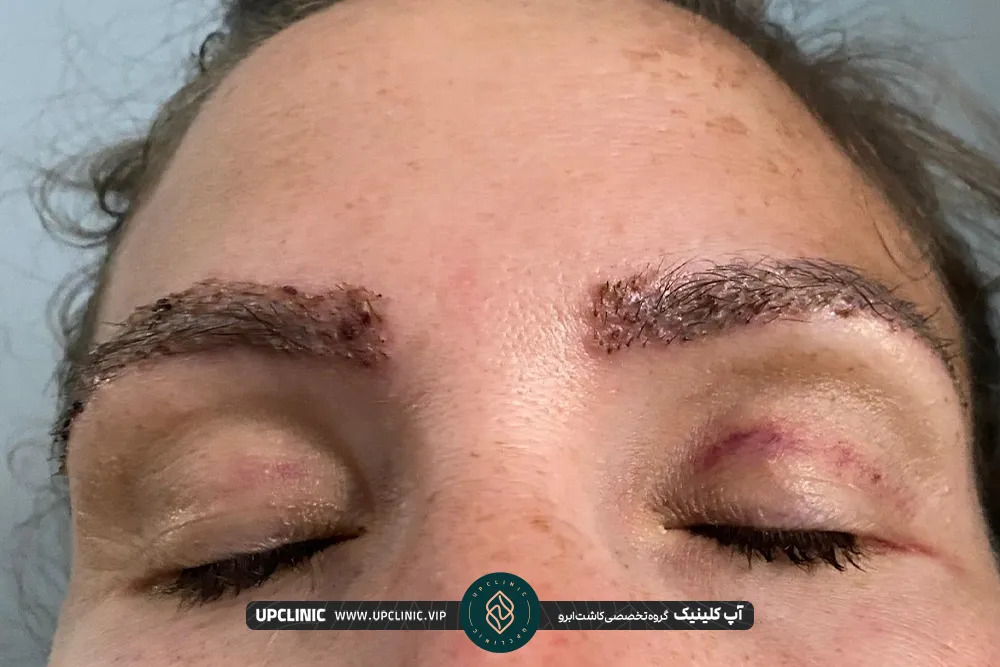 خانمی که خوابیده و ابروهایش پس از کاشت ابرو دلمه زده است
