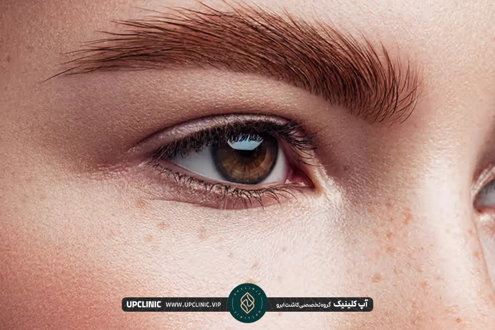 What is eyebrow implantation by FIT method?