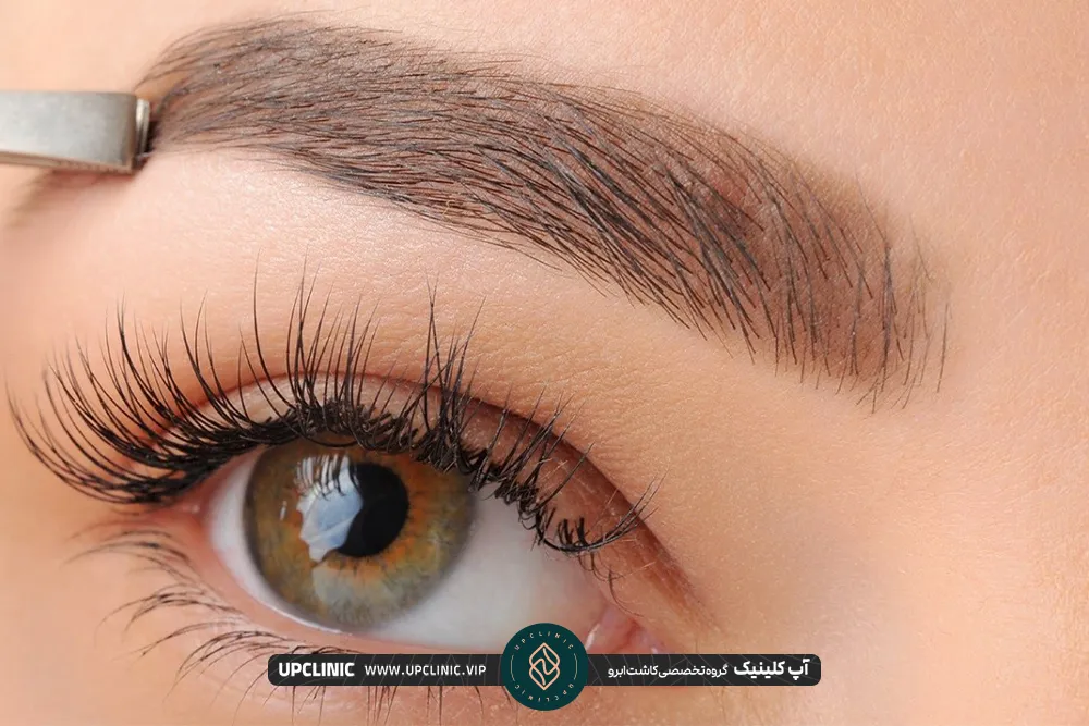 Wide eyebrow implantation by SUT method