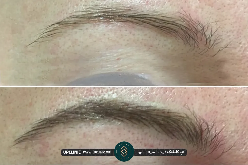 Wide eyebrow implantation by micrograft method