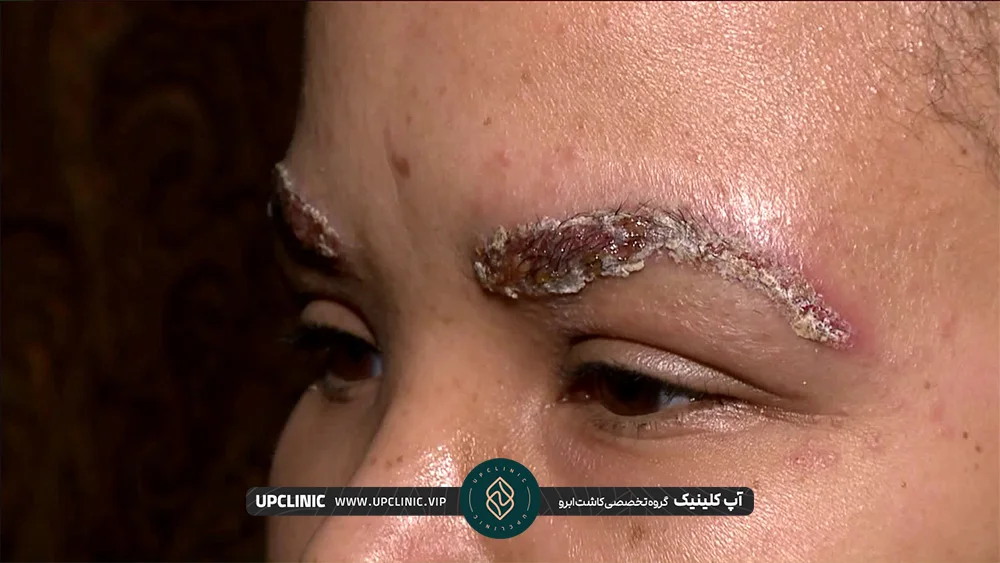 عکس عفونت هر دو ابرو