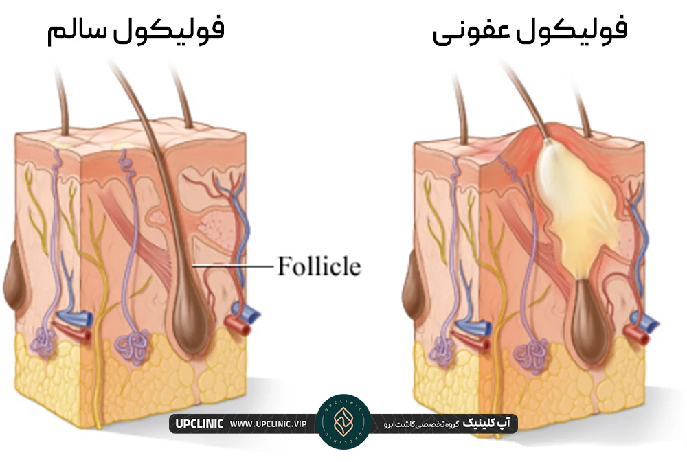 عکس فولیکول سالم مو در سمت چپ و فولیکول عفونی در سمت راست
