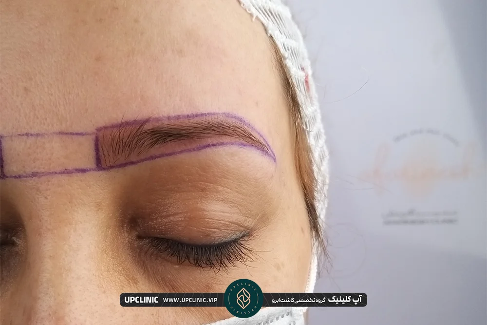 طراحی ابرو روی صورت زن قبل از کاشت - کاشت ابرو به روش SUT