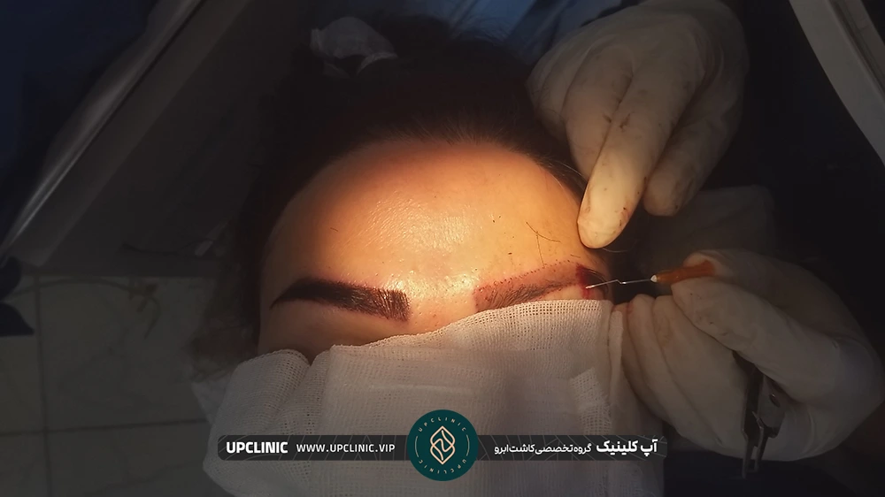 پزشک در حال کاشتن گرافت های مو در ابروی زن