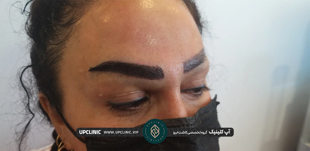 عکس زنی که کاشت ابرو انجام داده است